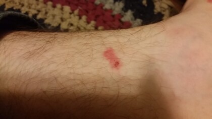 How to Get Rid of Chiggers in Home / Yard - Kill them!